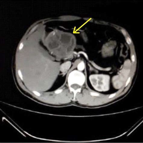 Axial Contrast Enhanced Ct Scan Of The Abdomen Demonstrating A
