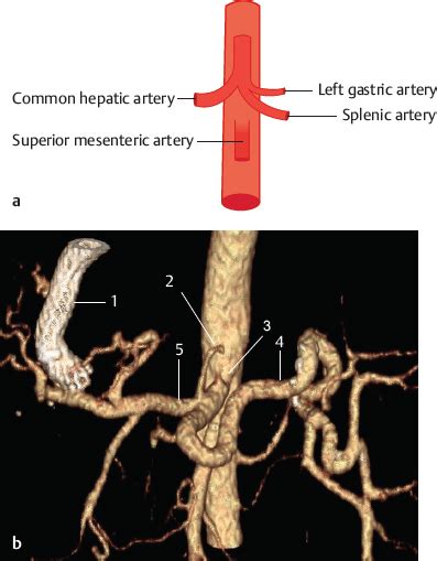 Celiac Trunk Radiology Key