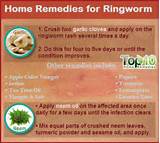 Home Remedies Ringworm Scalp Pictures