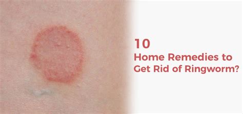How To Get Rid Of Ringworm Permanently At Home