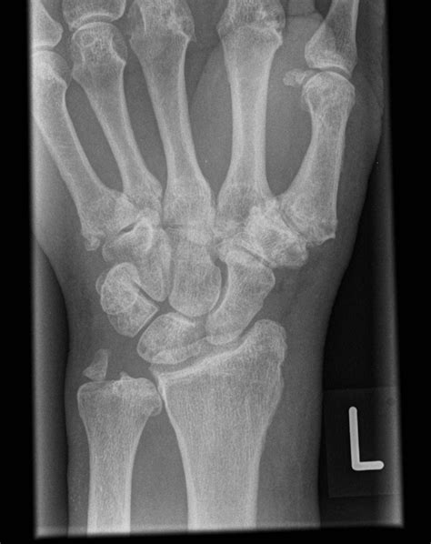 Triquetral And Wrist Fractures Image