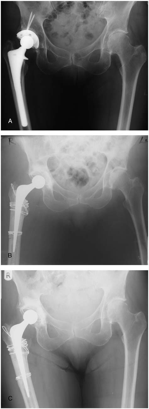 Extended Trochanteric Osteotomy Followed By Cemented Impaction