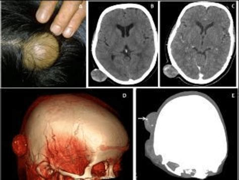 38 Years Female Presented With Right Occipital Scalp Swelling For Last