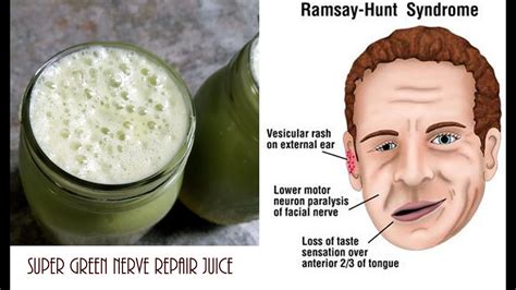 Ini berkembang mendadak, biasanya di satu sisi wajah. GREEN NERVE REPAIR JUICE RECIPE~ Ramsay hunt syndrome and ...