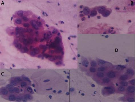 A Group Of Endocervical Cells Exhibiting Atypical Squamous Metaplasia Download Scientific