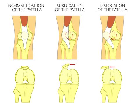 Patellar Dislocation And Recurrent Patellar Dislocation Knee Hip And Shoulder