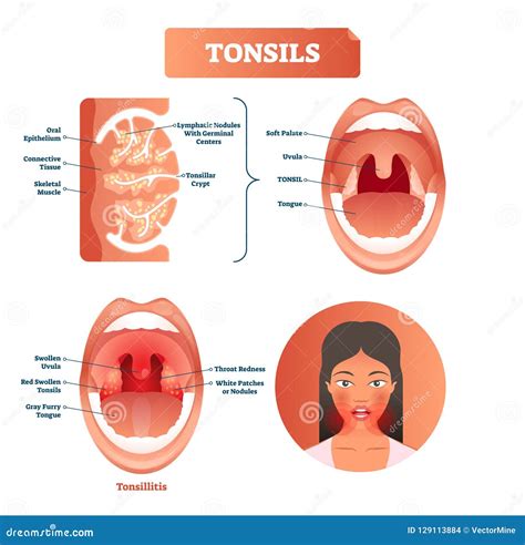 Tonsil Stones Vector Illustration Labeled Medical Stock Vector Royalty
