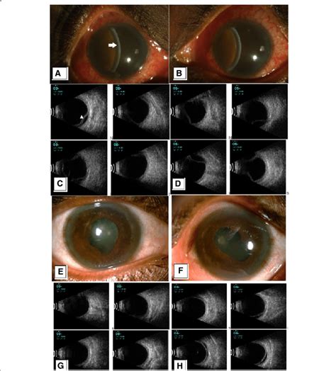 A And B Colour Slit Lamp Photograph Of The Right And Left Eye Showing