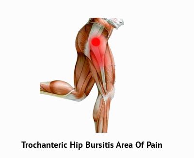 Trochanteric Hip Bursitis Rehab Runners