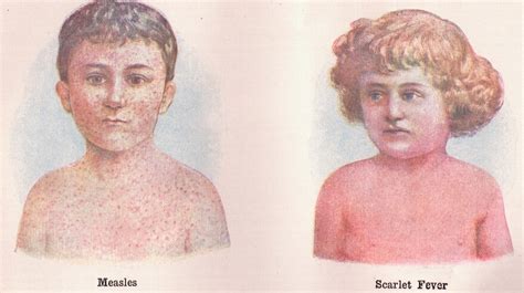 Scarlet Fever A Deadly History And How It Prevails