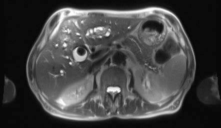 Mirizzi Syndrome Radiology Reference Article Radiopaedia Org