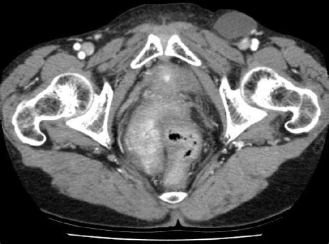 A Mesothelial Cyst Presenting As Inguinal Mass Two Case Reports And