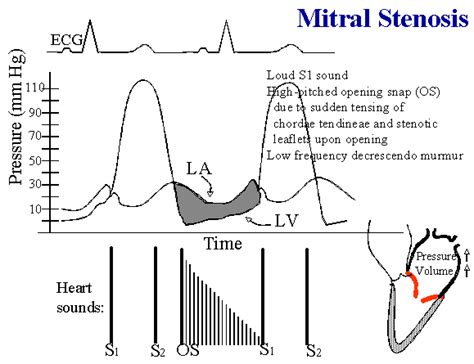 Aortic Valve Stenosis Heart Sound Les Baux De Provence