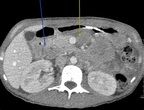 Cureus Obstructing Duodenal Diffuse Large B Cell Lymphoma With