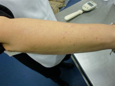 Armsscaly They Leave Scars Which Are Noticable And Unsightly