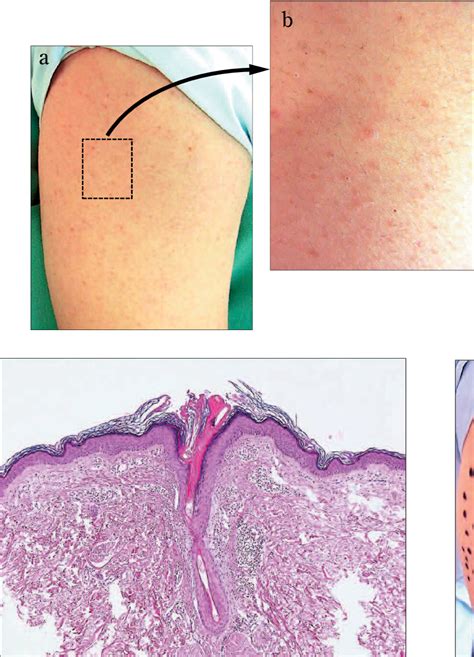 Figure 1 From Treatment Of Lichen Pilaris With A Q Switched Ndyag