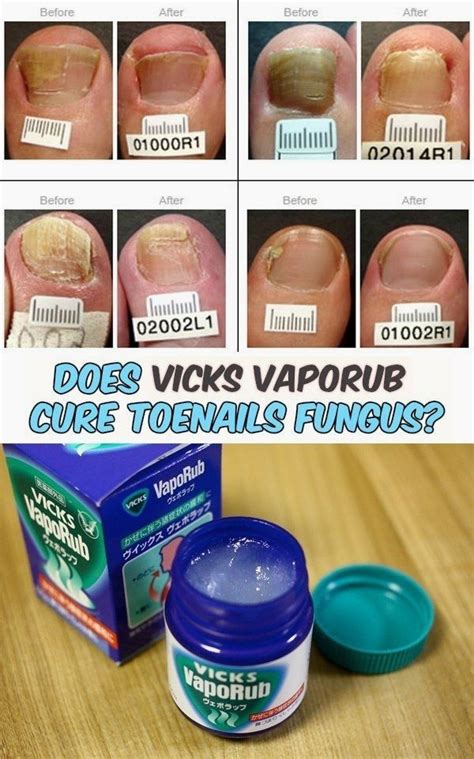 Read Directions About Vicks Vaporub And Its Benefits On Curing Toenail