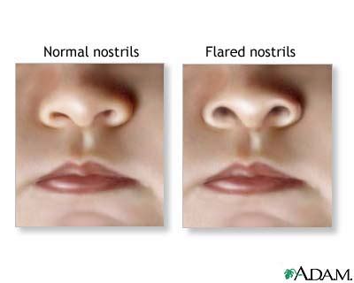 Nasal Flaring MedlinePlus Medical Encyclopedia Image