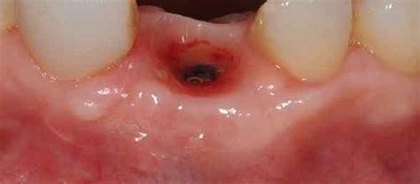 Alveolitis Dental Húmeda Clínica Dental En Dos Hermanas