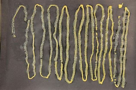 Huge Nine Foot Tapeworm Found Inside Stomach Of Man Who Loved Eating