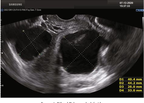 Figure 1 From Isolated Fallopian Tube Torsion A Rare Entity Semantic