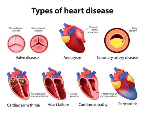 Heart Disease Causes Symptoms And Treatment Clicks Health Hub