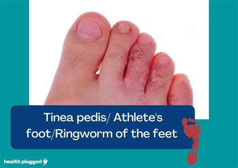 Tinea Pedis Symptoms Pictures Diagnosis Treatment And Prevention