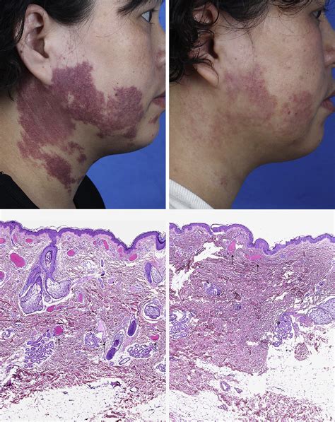 Port Wine Stains On The Neck Respond Better To A Pulsed Dye Laser Than