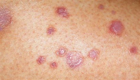 Diabetes Skin Rashes Pictures