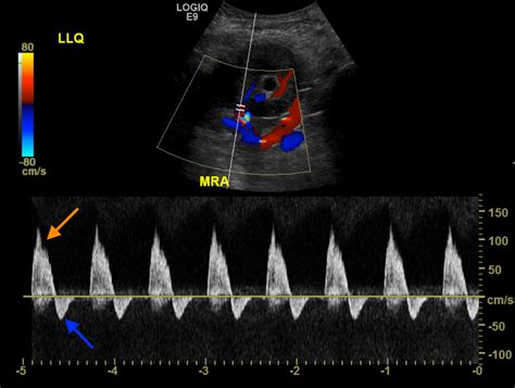 Fundamental Radiological Findings Reversed Diastolic Flow In The Renal