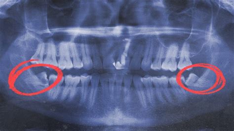 Impacted Wisdom Teeth Symptoms And Removal