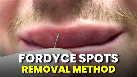 How To Remove Fordyce Spots Fordyce Spots Removal With Needle Method