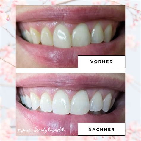 Schöne und gesunde zähne spielen eine wichtige rolle für ihr wohlbefinden, ihre ausstrahlung und ihre lebensqualität. Bleaching Vorher Nachher / Bleaching Zahnaufhellung - 8 ...