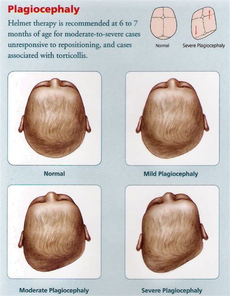 Punca Bayi Alami Sindrom Flat Head And Ini 6 Bantal Yang Sesuai Untuk Mereka