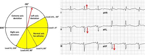 In the vast majority of cases, this is the. ECG demonstrates abnormal left-axis deviation de fi ned as ...