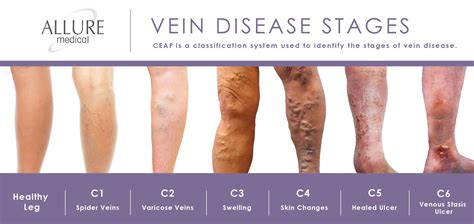 Classification Of Venous Disease