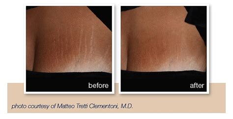 Treatment For Stretch Marks Southampton From Xavier G Medical Clinic