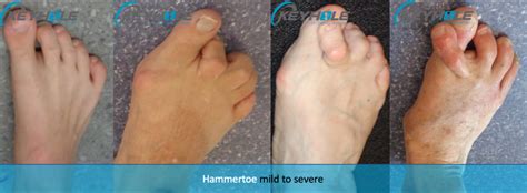 Minimally Invasive Hammertoe Surgery Perth Perth Podiatric Surgery