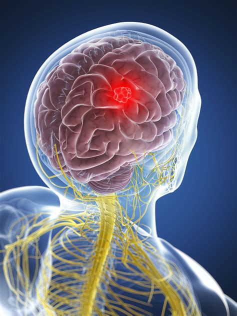 Overview Of Headaches From A Brain Tumor