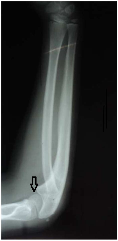 Pre Operative X Ray Showing Congenital Radial Head Dislocation With The