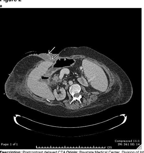 Figure 2 From Bleeding Enterocutaneous Fistula In Crohn S Disease