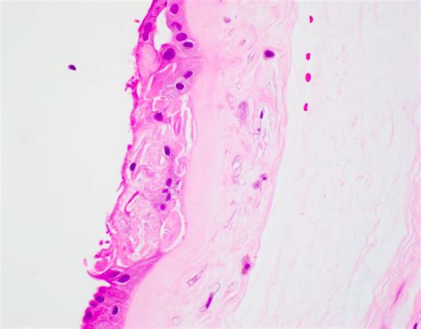 Pathology Outlines Amnion Nodosum