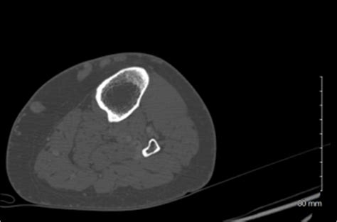 Figure 1 Ct Of Patients Left Lower Extremity With Iv Contrast