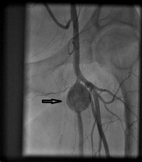 Angiogram Showing No Significant Disease In Left Superficial Femoral