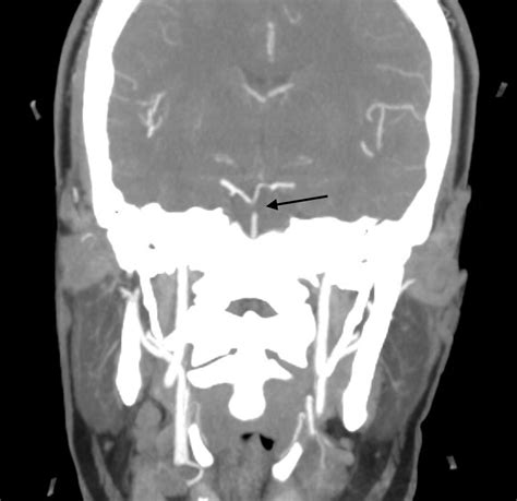Cureus A Case Report Of Basilar Artery Occlusion In A Healthy Year Old Female