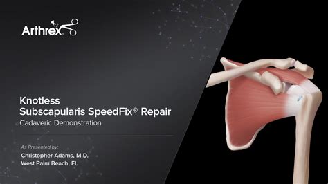 Arthrex Subscapularis Repair