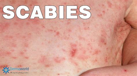 What Are Scabies How Are They Caused How To Cure Them Youtube