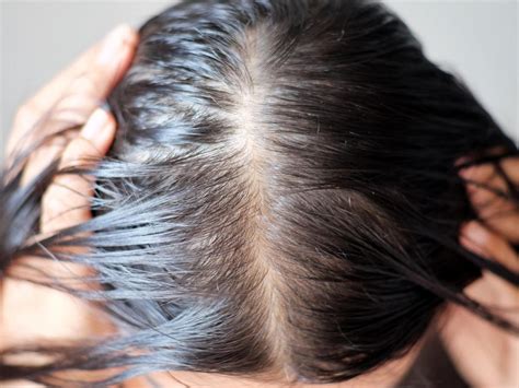 Patients Say Ozempic Is Triggering Hair Loss And Doctors Arent Surprised