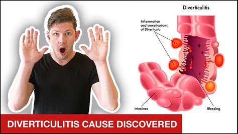 The Ultimate Diverticulitis Treatment Plan 4 Simple Steps Youtube