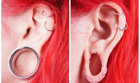earlobe repair surgery for stretched or split ear lobes earlobes reconstruction